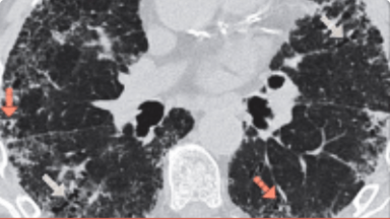 HRCT image of Bronchiolectasis.