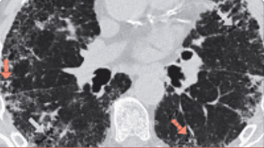 HRCT image of Bronchiolectasis.