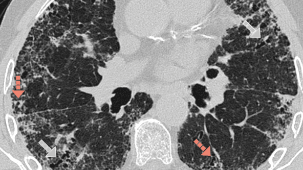 Example of ILD traction bronchiectasis / bronchiolectasis on HRCT