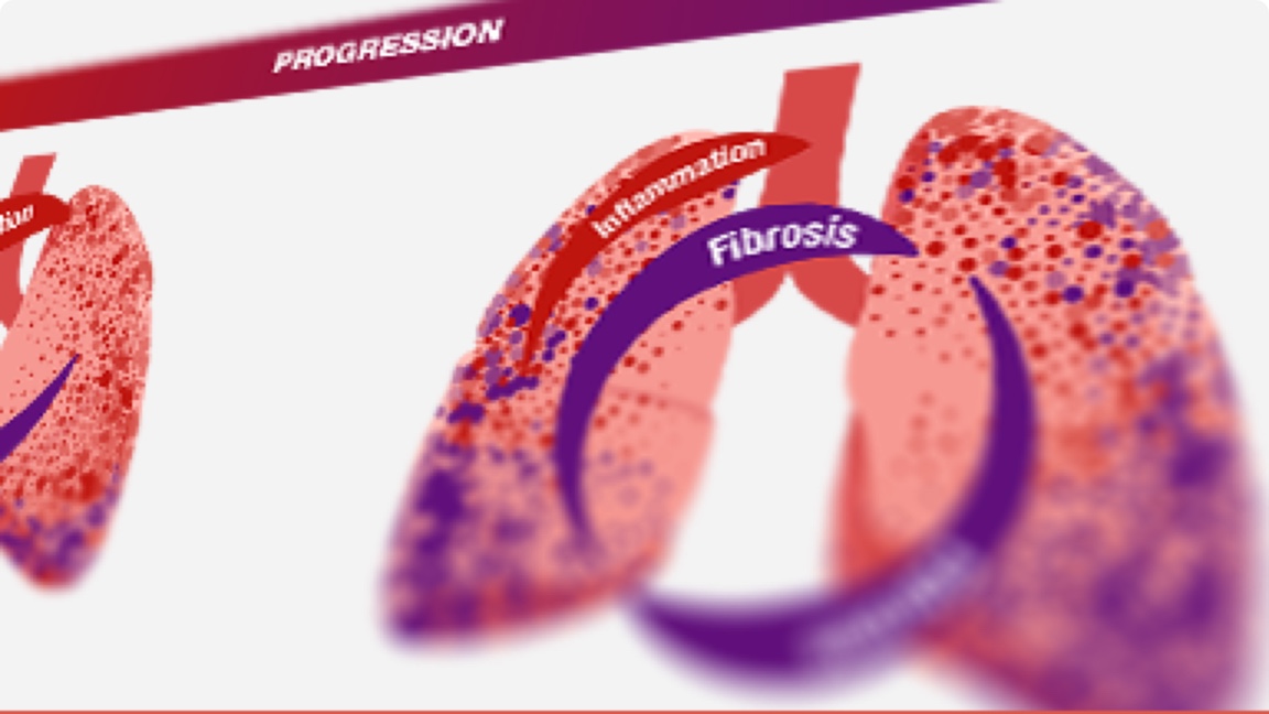 Inflammation and fibrosis in CTD-ILDs