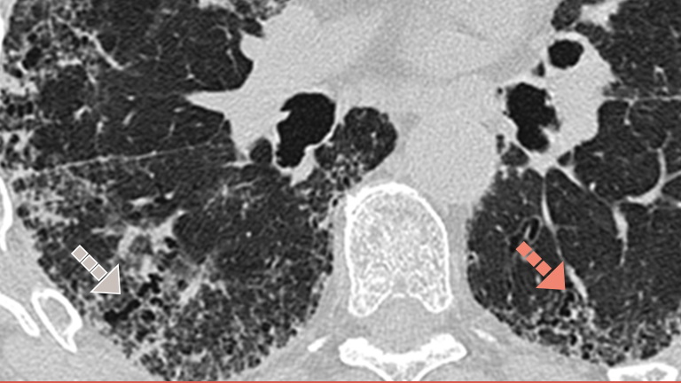 lung scan