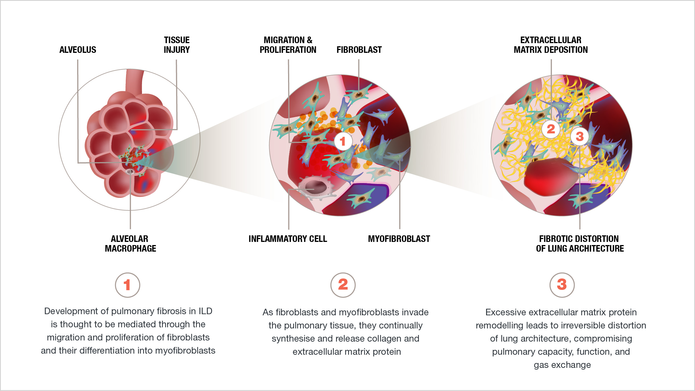 Pathogenic pathways of fibrogenesis in CTD-ILDs