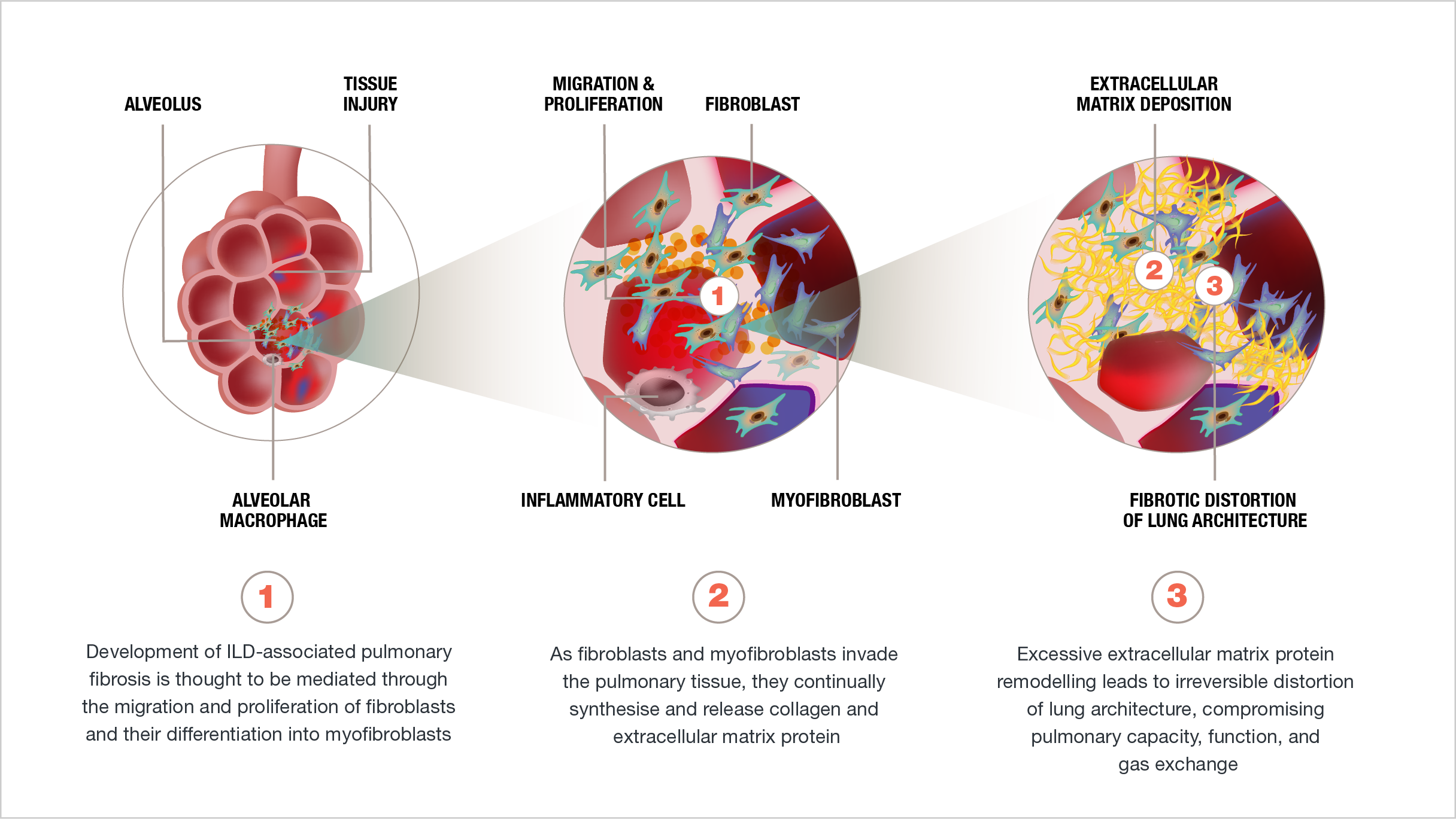 Pathogenic pathways of fibrogenesis