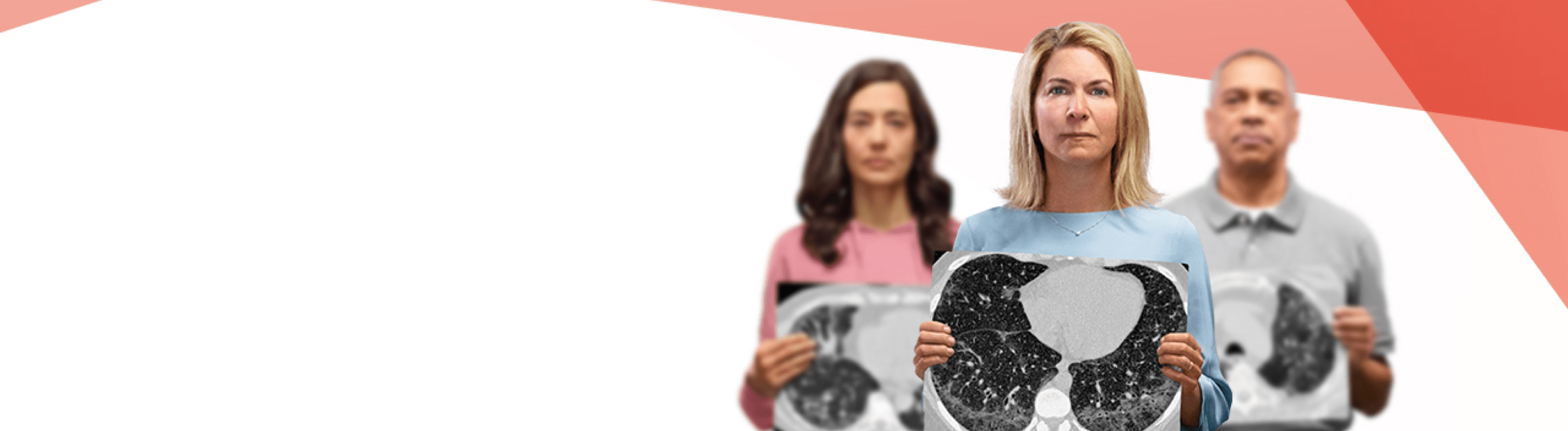 Progressive pulmonary fibrosis (PPF)