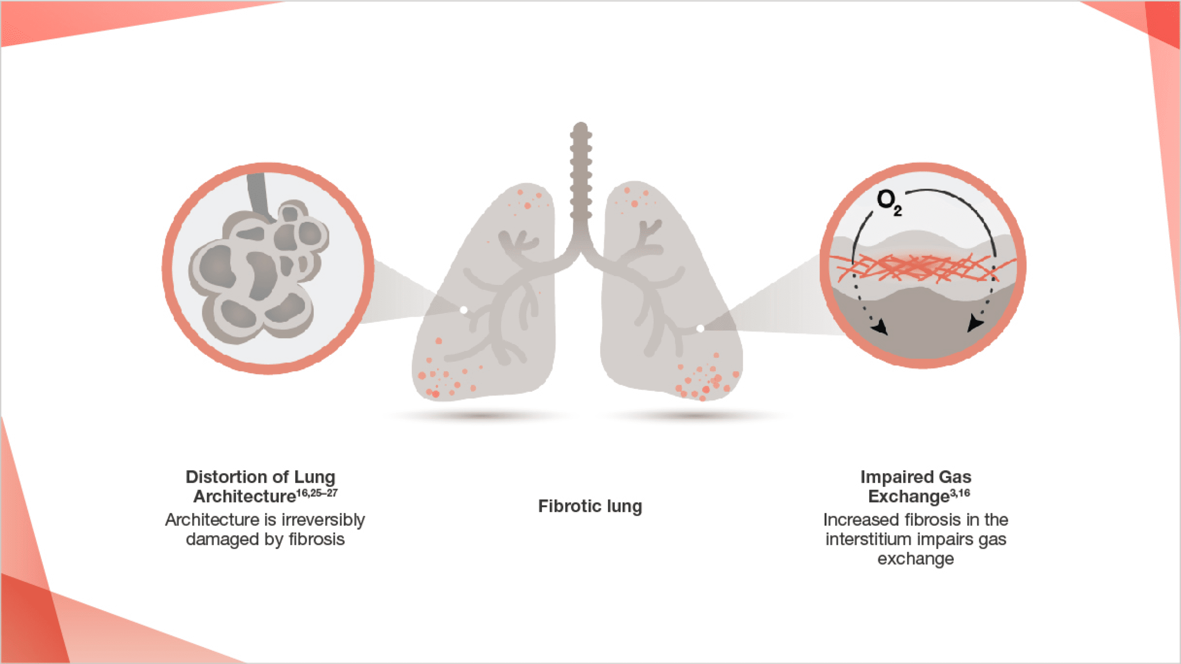 pulmonary fibrosis scars and stiffens tissue