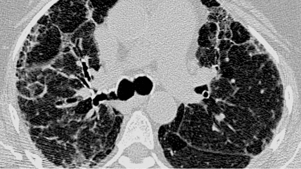 Example of cHP pattern on HRCT