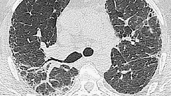 Example of sarcoidosis-associated interstitial lung disease pattern on HRC