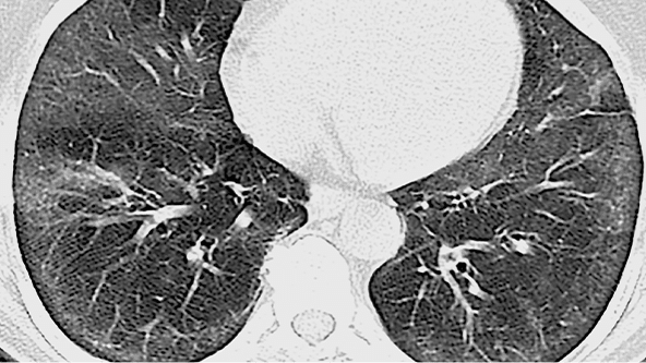 Example of iNSIP pattern on HRCT
