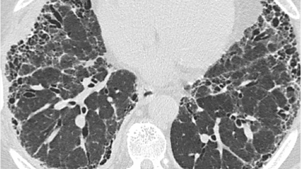 Example of IPF UIP pattern on HRCT