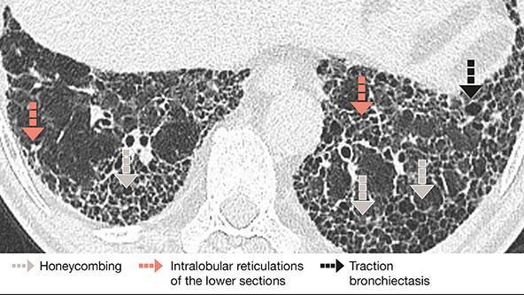 Example of ILD Honeycombing in HRCT 